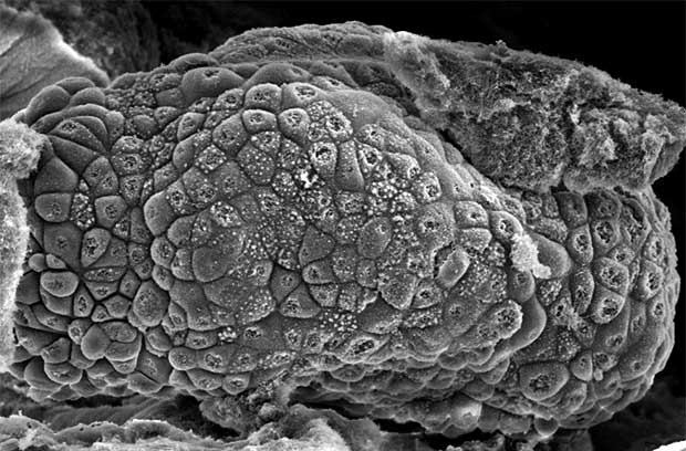 Ovarian Cancer